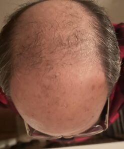 6 Months Kirkland Minoxidil 5% Extra Strength Hair Loss Regrowth Treatment Men, 12 Fl Oz (Pack of 6) 32 61Q02kqf0VL