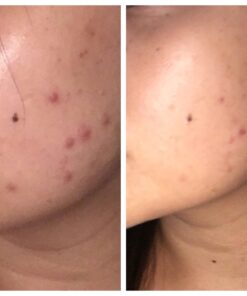 InstaNatural BHA Exfoliating Face Serum, Minimizes Lines, Wrinkles, and Blemishes, with Vitamin C and Salicylic Acid, 1 Fl Oz 41 61Q9zPPdqVL