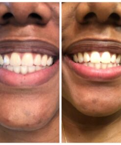 Auraglow 35% Teeth Whitening Gel Syringe Refill Pack, 35% Carbamide Peroxide, 30 Whitening Treatments, (3) 5mL Whitening Gel Syringes, Sensitive Teeth Whitening 41 61QryWYCwVL