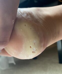 Compound W Maximum Strength Fast Acting Liquid Wart Remover, 0.31 fl oz 42 61Riw7dT4uL