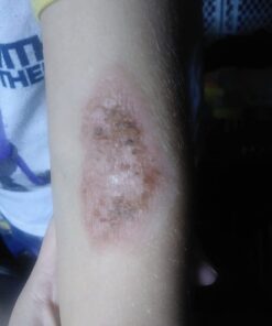 SkinSmart Antimicrobial Eczema Therapy with Hypochlorous Acid, Removes Bacteria so Skin Can Heal, for Adults, Kids and Seniors, 8 Ounce Clear Spray 8 Fl Oz (Pack of 1) 40 61UD2j3nLhL