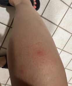 TEA TREE OIL BALM -100% All Natural | Great Cream for Soothing Irritations like Eczema, Psoriasis, Rashes, Insect Bites, Folliculitis, Acne, Itches, Dry Chapped Heels, Cuticles, Saddle Sores and more! 50 61W33ZMkHL