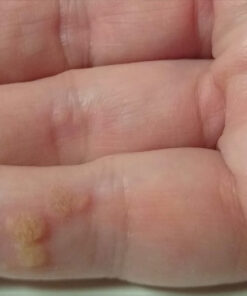 Dr. Scholl's Clear Away WART Remover HYDROGEL Bandage // 12 Discs/9 Cushions, Clinically Proven, Immediate & All-Day Cushioning Pain Relief, Multi-Day Coverage, 12 Treatments 42 61XzvgZndvL