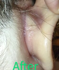 TEA TREE OIL BALM -100% All Natural | Great Cream for Soothing Irritations like Eczema, Psoriasis, Rashes, Insect Bites, Folliculitis, Acne, Itches, Dry Chapped Heels, Cuticles, Saddle Sores and more! 44 61ZPUyEWNCL