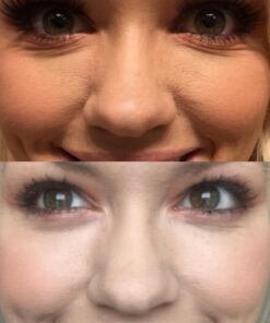 Silk’N Revit - Blackhead Remover Vacuum - Microdermabrasion Machine - Cleansing Exfoliating Face Scrub Pore Vacuum 39 61cPhiw7KhL