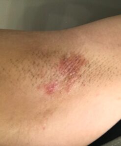 Cammile Q Organic Tamanu Oil - Natural Psoriasis Treatment - Great For Eczema, Acne & Scars - Cold Pressed 45 61dzbtaS9GL