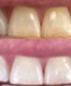 Auraglow 35% Teeth Whitening Gel Syringe Refill Pack, 35% Carbamide Peroxide, 30 Whitening Treatments, (3) 5mL Whitening Gel Syringes, Sensitive Teeth Whitening 29 61e 1CfDOL