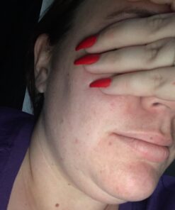 Nature's Cure Body Acne Treatment Spray - 3.5 fl oz (Pack of 1) 17 61ffF22CjEL