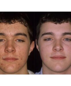 Acnetame Acne Pills- Vitamin Supplements for Acne Treatment- Natural Clear Skin from Hormonal Cystic Pimples- Oily Skin Vitamins Pill for Women, Teen, Men, & Adults 60 Tablets 60 Count (Pack of 1) 32 61gzu1uU9cL 1