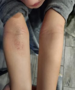 TEA TREE OIL BALM -100% All Natural | Great Cream for Soothing Irritations like Eczema, Psoriasis, Rashes, Insect Bites, Folliculitis, Acne, Itches, Dry Chapped Heels, Cuticles, Saddle Sores and more! 55 61h2XYDEWwL