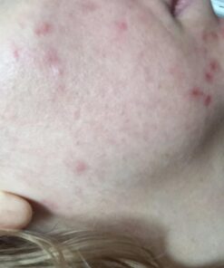 Estroblock PRO Triple Strength - 60 Capsules, DIM & Indole 3-Carbinol for Natural Hormonal Hormone Balance, Acne - Anti Toxic Estrogen Aromatase Inhibitor Blocker. Soy Free, Dairy Free, Non-GMO (1) 1 59 61h8J2NbmL 2