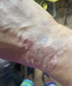 SkinSmart Antimicrobial Eczema Therapy with Hypochlorous Acid, Removes Bacteria so Skin Can Heal, for Adults, Kids and Seniors, 8 Ounce Clear Spray 8 Fl Oz (Pack of 1) 50 61hLuQpORzL