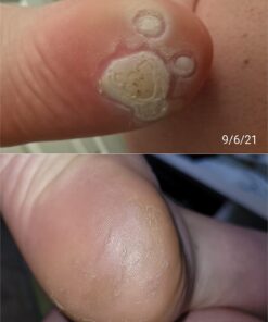 Compound W Maximum Strength Fast Acting Gel Wart Remover, 0.25 oz, 2 Pack unflavored 0.5 Ounce (Pack of 1) 43 61hlURsAcCL