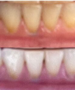 Auraglow 35% Teeth Whitening Gel Syringe Refill Pack, 35% Carbamide Peroxide, 30 Whitening Treatments, (3) 5mL Whitening Gel Syringes, Sensitive Teeth Whitening 30 61hsOicsOLL