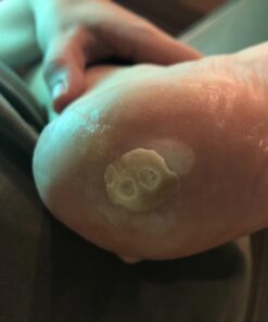 Compound W Nitrofreeze | Wart Removal | 1 Pen & 5 Replaceable Tips 56 61iarAyWkAL 2