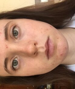 ClearZine Acne Pills for Teens & Adults (2 Bottles) | Clear Skin Supplement, Vitamins for Hormonal & Cystic Acne, 90 Caps Each 29 61it3UYKSQL