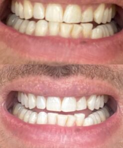 Crest 3D Whitestrips, Glamorous White, Teeth Whitening Strip Kit, 28 Strips (14 Count Pack) Flavorless 28 Count (Pack of 1) 32 61jAoVKiv5L