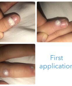 Dr. Scholl's Clear Away WART Remover HYDROGEL Bandage // 12 Discs/9 Cushions, Clinically Proven, Immediate & All-Day Cushioning Pain Relief, Multi-Day Coverage, 12 Treatments 37 61jNEAX6IzL