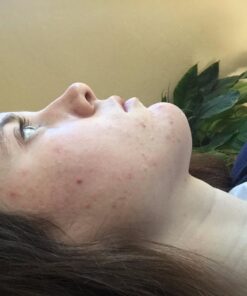 ClearZine Acne Pills for Teens & Adults (2 Bottles) | Clear Skin Supplement, Vitamins for Hormonal & Cystic Acne, 90 Caps Each 32 61kGEH7MiDL 1