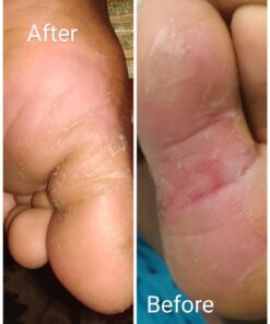 Brave Soldier Antiseptic Healing Ointment - Best Wound Care & Skin Repair Cream with Tea Tree Oil - First Aid Supplies for Burns, Wounds & More, 1 Ounce 63 61kZkkKdtL