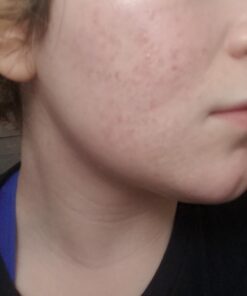 Organic Rosehip Oil – 100% Pure Unrefined Cold Pressed Rosehip Seed Oil - Best Moisturizer for Face, Hair - Great for Fine Lines, Wrinkles, Acne Scars, Sun Damage, Stretch Marks, Eczema, Psoriasis 4 Fl Oz (Pack of 1) 31 61mcd1GXL