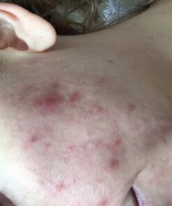 Estroblock PRO Triple Strength - 60 Capsules, DIM & Indole 3-Carbinol for Natural Hormonal Hormone Balance, Acne - Anti Toxic Estrogen Aromatase Inhibitor Blocker. Soy Free, Dairy Free, Non-GMO (1) 1 60 61nr8yJqh5L 2