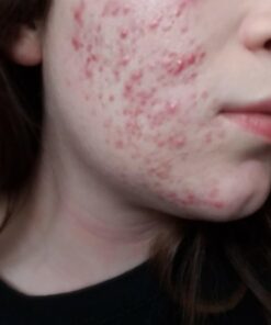 Organic Rosehip Oil – 100% Pure Unrefined Cold Pressed Rosehip Seed Oil - Best Moisturizer for Face, Hair - Great for Fine Lines, Wrinkles, Acne Scars, Sun Damage, Stretch Marks, Eczema, Psoriasis 4 Fl Oz (Pack of 1) 32 61oMqaz5RL