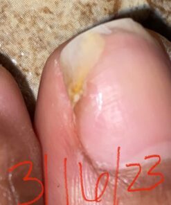 Toenail Fungus Treatment Extra Strength with 25% Undecylenic Acid - Fungal Nail Treatment for Toe Nail & Fingernails - Antifungal Nail Repair Solution for Discoloured & Ingrown Nails – Made in USA 0.5 Fl Oz (Pack of 1) 56 61p 8rfvnL 3