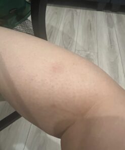 TEA TREE OIL BALM -100% All Natural | Great Cream for Soothing Irritations like Eczema, Psoriasis, Rashes, Insect Bites, Folliculitis, Acne, Itches, Dry Chapped Heels, Cuticles, Saddle Sores and more! 51 61ppaj77RzL