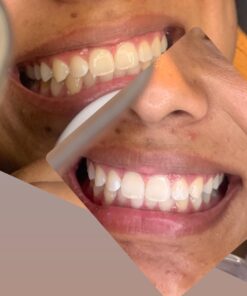 Auraglow 35% Teeth Whitening Gel Syringe Refill Pack, 35% Carbamide Peroxide, 30 Whitening Treatments, (3) 5mL Whitening Gel Syringes, Sensitive Teeth Whitening 33 61pv6Jfp13L