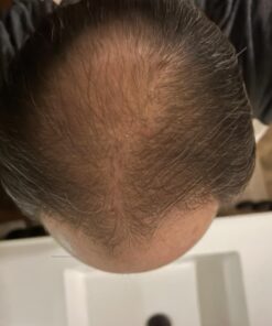 6 Months Kirkland Minoxidil 5% Extra Strength Hair Loss Regrowth Treatment Men, 12 Fl Oz (Pack of 6) 33 61qaV7komTL