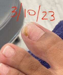 Toenail Fungus Treatment Extra Strength with 25% Undecylenic Acid - Fungal Nail Treatment for Toe Nail & Fingernails - Antifungal Nail Repair Solution for Discoloured & Ingrown Nails – Made in USA 0.5 Fl Oz (Pack of 1) 57 61r63LoS1AL 3