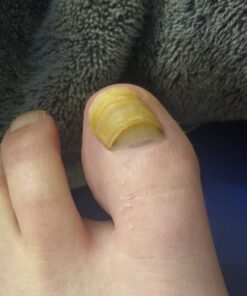 Kerasal Nail Renewal, Restores Appearance of Discolored or Damaged Nails, 0.33 fl oz (Packaging May Vary) 35 61rE8mwvrzL