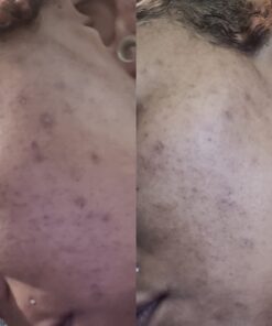 Premium African Black Soap - Pure 1 pound Bulk. Raw Organic Soap for Acne, Dry Skin, Rashes, Burns, Scar Removal, Face & Body Wash, From Ghana West Africa - Authentic African Moisturizer 37 61td1fLhGTL 1