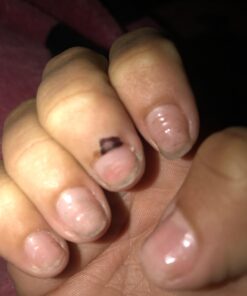 Compound W Nitrofreeze | Wart Removal | 1 Pen & 5 Replaceable Tips 60 61uiAvybCyL 2