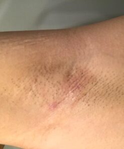 Cammile Q Organic Tamanu Oil - Natural Psoriasis Treatment - Great For Eczema, Acne & Scars - Cold Pressed 46 61wl77Qkj L