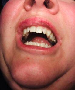 Auraglow 35% Teeth Whitening Gel Syringe Refill Pack, 35% Carbamide Peroxide, 30 Whitening Treatments, (3) 5mL Whitening Gel Syringes, Sensitive Teeth Whitening 39 61x14Q hGZL