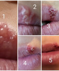 Abreva 10 Percent Docosanol Cold Sore Treatment, Treats Your Fever Blister in 2.5 Days - 0.07 oz Tube x 2 25 61y kg4VVjL