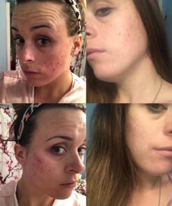 MAJESTIC PURE Bentonite Clay - Indian Healing Clay - Deep Pore Cleansing Mask - Clay Mask for Face, Hair, Acne, Detoxify and Skin Care - Sodium Bentonite Powder - Facial Mask for Men & Women - 20 oz 51 61yMherPIvL