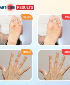 Warticide Fast-Acting Wart Remover - Plantar and Genital Wart Removal, Attacks Warts On Contact, Easy Application (1 Fluid Ounce) 1 Fl Oz (Pack of 1) 20 71 A3j0sZUL