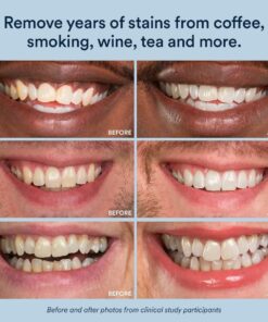 Auraglow 35% Teeth Whitening Gel Syringe Refill Pack, 35% Carbamide Peroxide, 30 Whitening Treatments, (3) 5mL Whitening Gel Syringes, Sensitive Teeth Whitening 28 71 A6 ZhaL