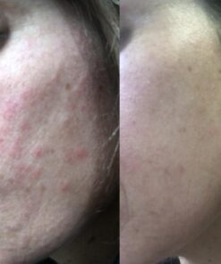 Organic Rosehip Oil – 100% Pure Unrefined Cold Pressed Rosehip Seed Oil - Best Moisturizer for Face, Hair - Great for Fine Lines, Wrinkles, Acne Scars, Sun Damage, Stretch Marks, Eczema, Psoriasis 4 Fl Oz (Pack of 1) 33 71 FdD7p9xL