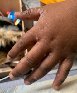 SkinSmart Antimicrobial Eczema Therapy with Hypochlorous Acid, Removes Bacteria so Skin Can Heal, for Adults, Kids and Seniors, 8 Ounce Clear Spray 8 Fl Oz (Pack of 1) 34 71 hcBtj1UL