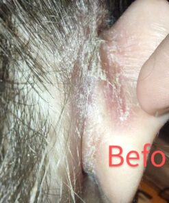 TEA TREE OIL BALM -100% All Natural | Great Cream for Soothing Irritations like Eczema, Psoriasis, Rashes, Insect Bites, Folliculitis, Acne, Itches, Dry Chapped Heels, Cuticles, Saddle Sores and more! 45 710tfhRRNmL