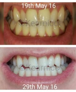 Crest 3D Whitestrips, Glamorous White, Teeth Whitening Strip Kit, 28 Strips (14 Count Pack) Flavorless 28 Count (Pack of 1) 30 712XCtCeA2L