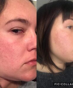 Artnaturals Rosehip Seed Oil 4 oz for Face, Hair & Skin - 100% Pure Natural, Cold Pressed & Unrefined Rose Hip Oil - Anti-Aging Moisturizer Facial Oil for Fine Lines, Scars & Wrinkles 56 713jb971dUL