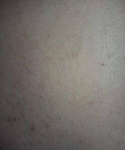 Acnetame Acne Pills- Vitamin Supplements for Acne Treatment- Natural Clear Skin from Hormonal Cystic Pimples- Oily Skin Vitamins Pill for Women, Teen, Men, & Adults 60 Tablets 60 Count (Pack of 1) 51 713q3NhKx4L 1