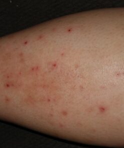 Antibacterial Skin Repair Max 3X Natural Ingredients - For Fissures Folliculitis Angular Cheilitis Impetigo Chilblains Lichen Sclerosus Cellulitis (14gm tube) 0.49 Ounce (Pack of 1) 19 713uk5Iqf1L 1