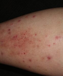 Antibacterial Skin Repair Max 3X Natural Ingredients - For Fissures Folliculitis Angular Cheilitis Impetigo Chilblains Lichen Sclerosus Cellulitis (14gm tube) 0.49 Ounce (Pack of 1) 20 714nR Tc7bL