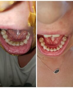 Dental Hygiene Kit - Calculus & Plaque Remover Dental Tool Set - Stainless Steel Tarter Scraper, Tooth Pick, and Mouth Mirror - Dentist Instrument Set for Teeth Cleaning (Blue) Blue 45 715RhNopNiL